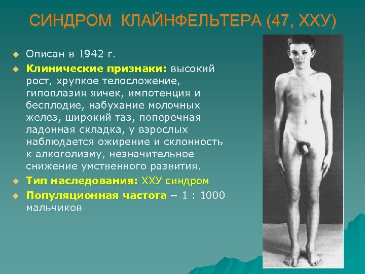 СИНДРОМ КЛАЙНФЕЛЬТЕРА (47, ХХУ) u u Описан в 1942 г. Клинические признаки: высокий рост,