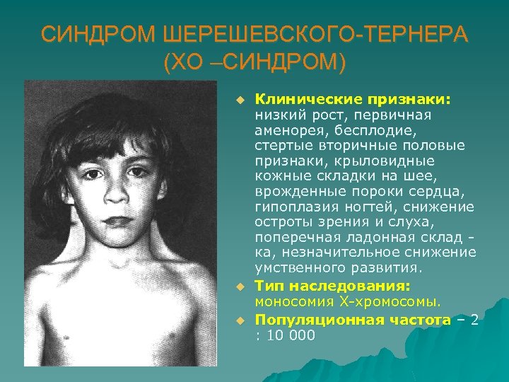 СИНДРОМ ШЕРЕШЕВСКОГО-ТЕРНЕРА (ХО –СИНДРОМ) u u u Клинические признаки: низкий рост, первичная аменорея, бесплодие,