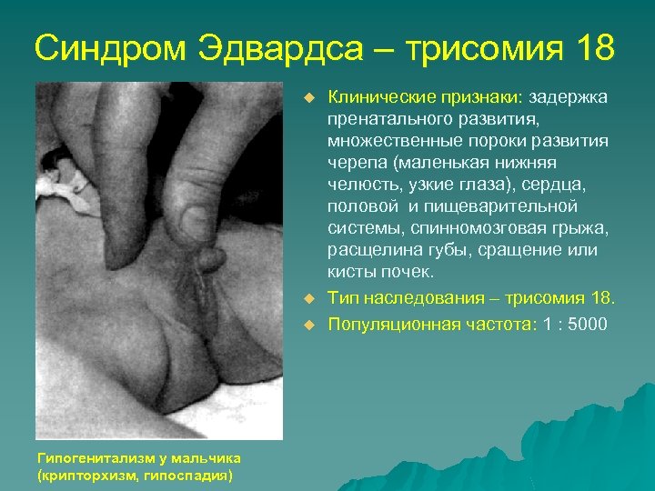 Синдром Эдвардса – трисомия 18 u u u Гипогенитализм у мальчика (крипторхизм, гипоспадия) Клинические