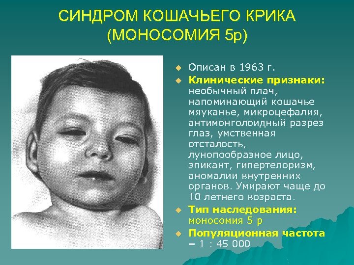 СИНДРОМ КОШАЧЬЕГО КРИКА (МОНОСОМИЯ 5 р) u u Описан в 1963 г. Клинические признаки: