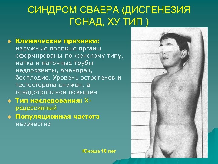 СИНДРОМ СВАЕРА (ДИСГЕНЕЗИЯ ГОНАД, ХУ ТИП ) u u u Клинические признаки: наружные половые