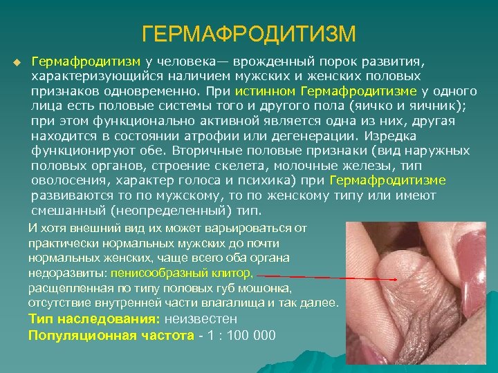 ГЕРМАФРОДИТИЗМ u Гермафродитизм у человека— врожденный порок развития, характеризующийся наличием мужских и женских половых