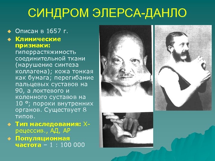 СИНДРОМ ЭЛЕРСА-ДАНЛО u u Описан в 1657 г. Клинические признаки: гиперрастяжимость соединительной ткани (нарушение