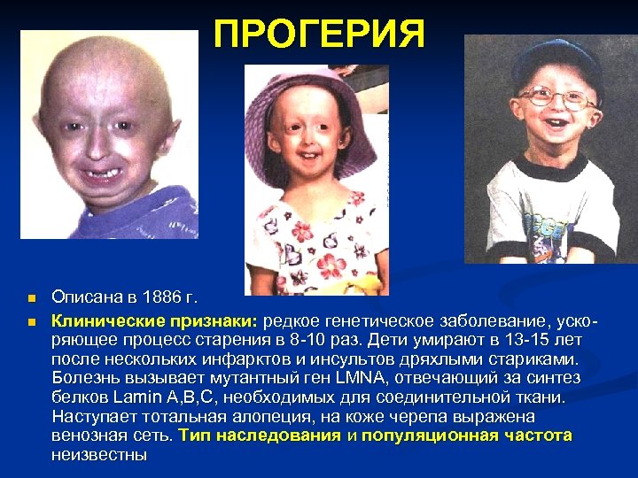 ПРОГЕРИЯ n n Описана в 1886 г. Клинические признаки: редкое генетическое заболевание, ускоряющее процесс
