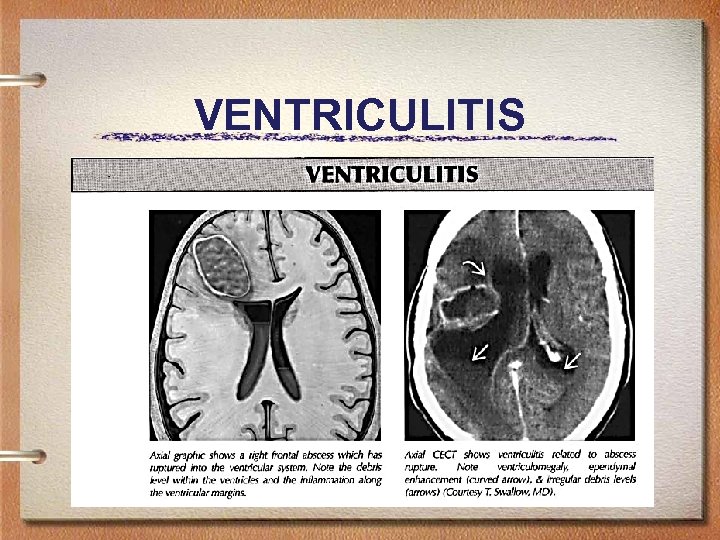 VENTRICULITIS 