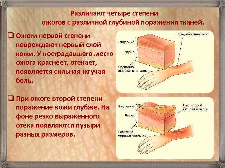  Pазличают четыре степени ожогов с различной глубиной поражения тканей. q Ожоги первой степени