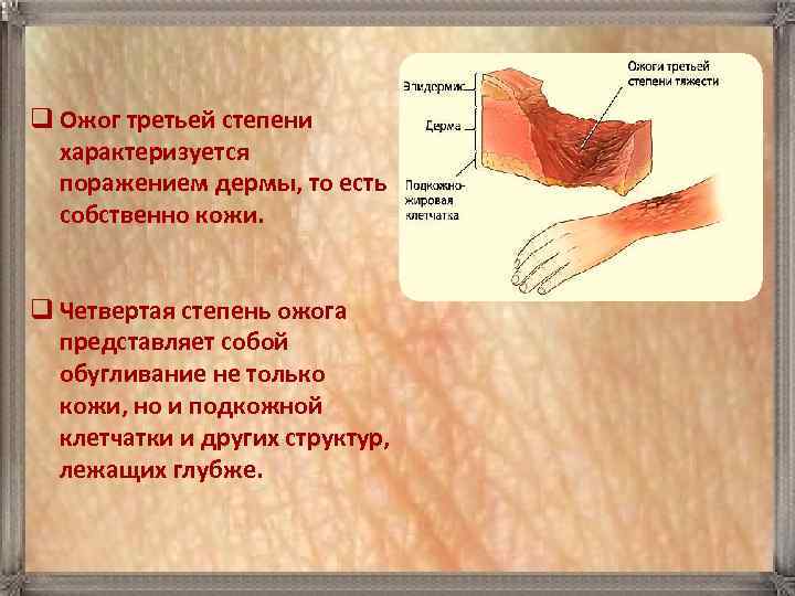 q Ожог третьей степени характеризуется поражением дермы, то есть собственно кожи. q Четвертая степень