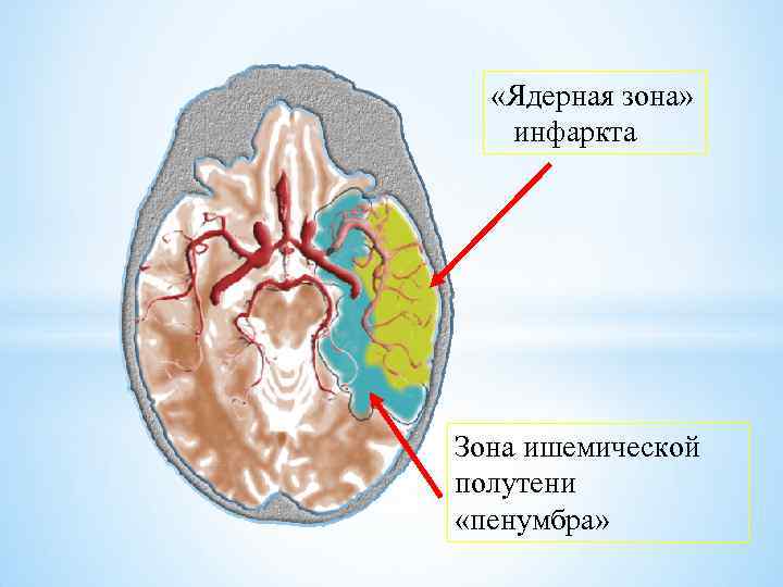  «Ядерная зона» инфаркта Зона ишемической полутени «пенумбра» 