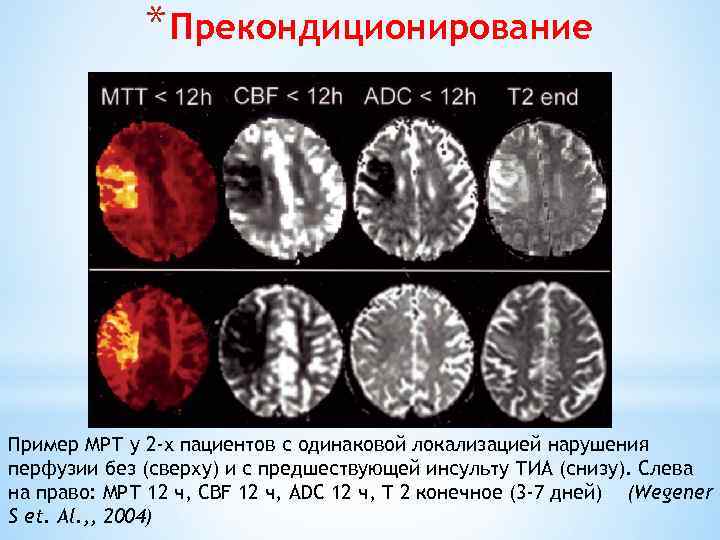 * Прекондиционирование Пример МРТ у 2 -х пациентов с одинаковой локализацией нарушения перфузии без