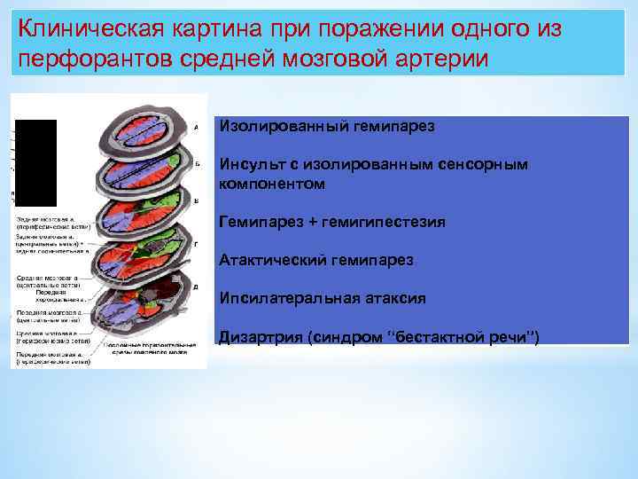 Клиническая картина при поражении одного из перфорантов средней мозговой артерии Изолированный гемипарез Инсульт с