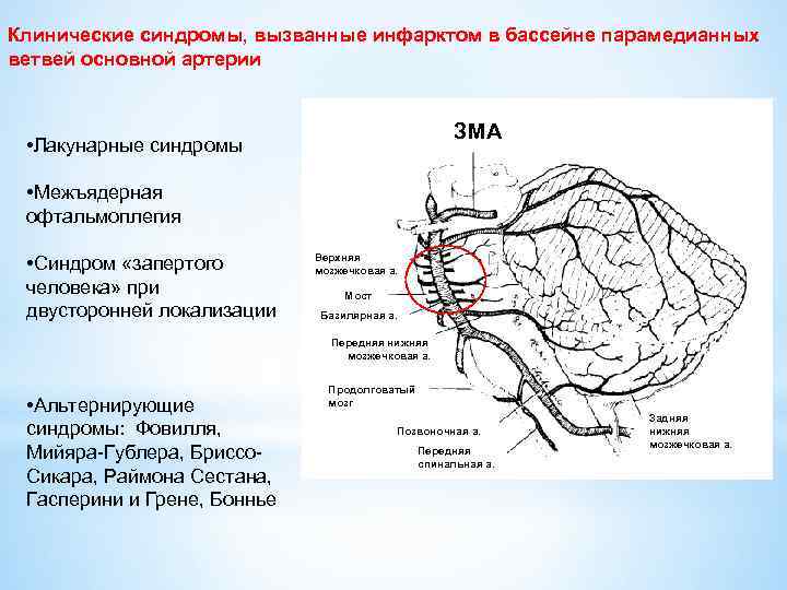 Клинические синдромы, вызванные инфарктом в бассейне парамедианных ветвей основной артерии ЗМА • Лакунарные синдромы