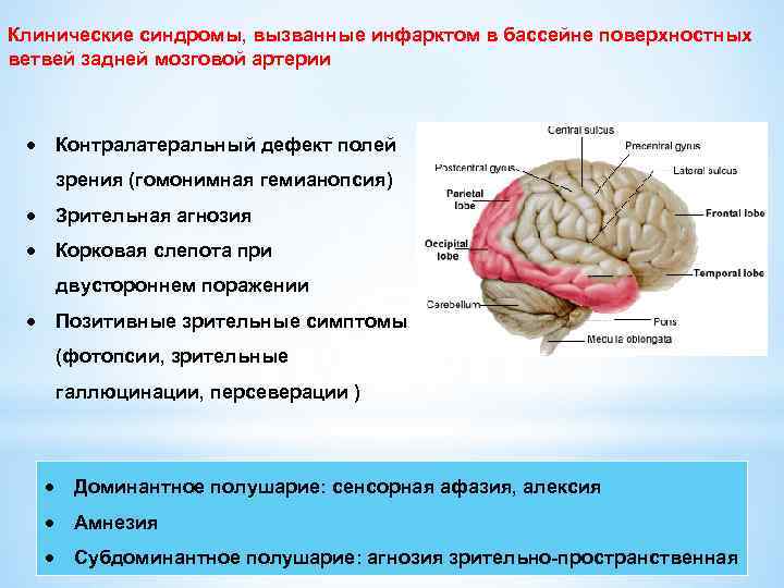 Клинические синдромы, вызванные инфарктом в бассейне поверхностных ветвей задней мозговой артерии Контралатеральный дефект полей