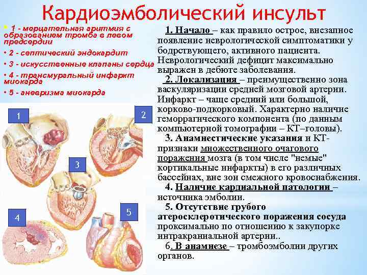 Кардиоэмболический инсульт • 1 - мерцательная аритмия с образованием тромба в левом предсердии •