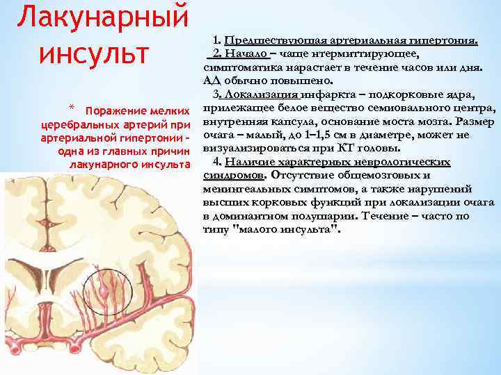  Лакунарный 1. Предшествующая артериальная гипертония. 2. Начало – чаще нтермиттирующее, инсульт симптоматика нарастает