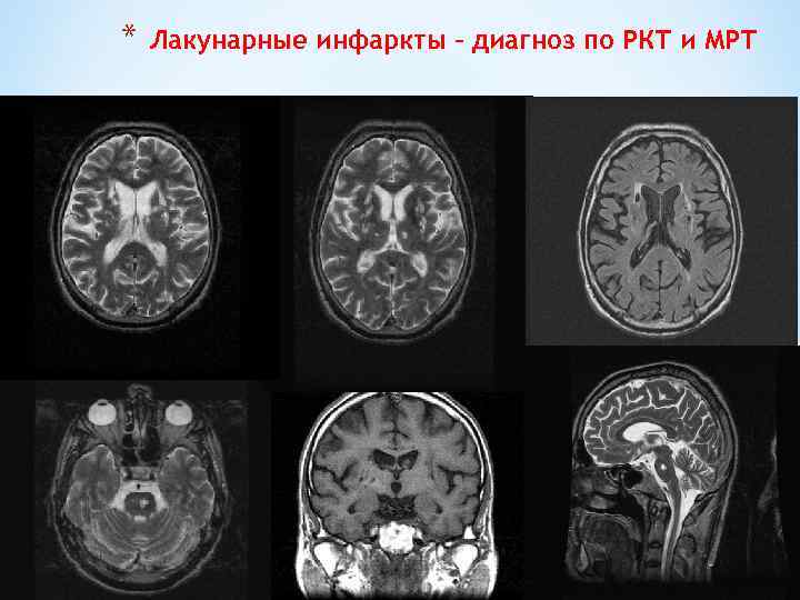 * Лакунарные инфаркты – диагноз по РКТ и МРТ 