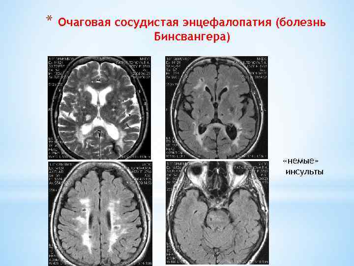 * Очаговая сосудистая энцефалопатия (болезнь Бинсвангера) «немые» инсульты 