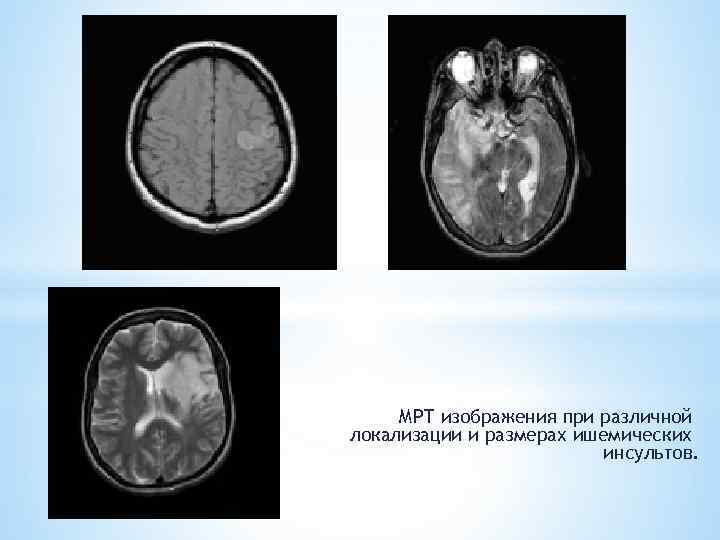 МРТ изображения при различной локализации и размерах ишемических инсультов. 