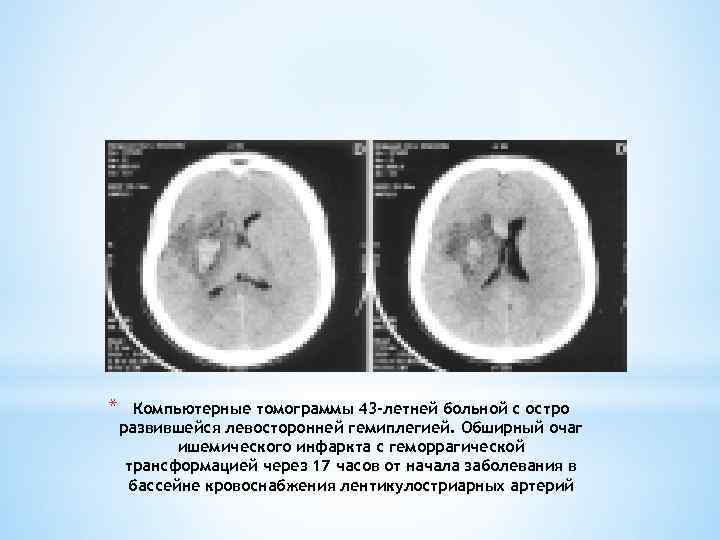 * Компьютерные томограммы 43 -летней больной с остро развившейся левосторонней гемиплегией. Обширный очаг ишемического