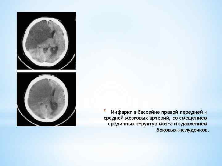 * Инфаркт в бассейне правой передней и средней мозговых артерий, со смещением срединных структур