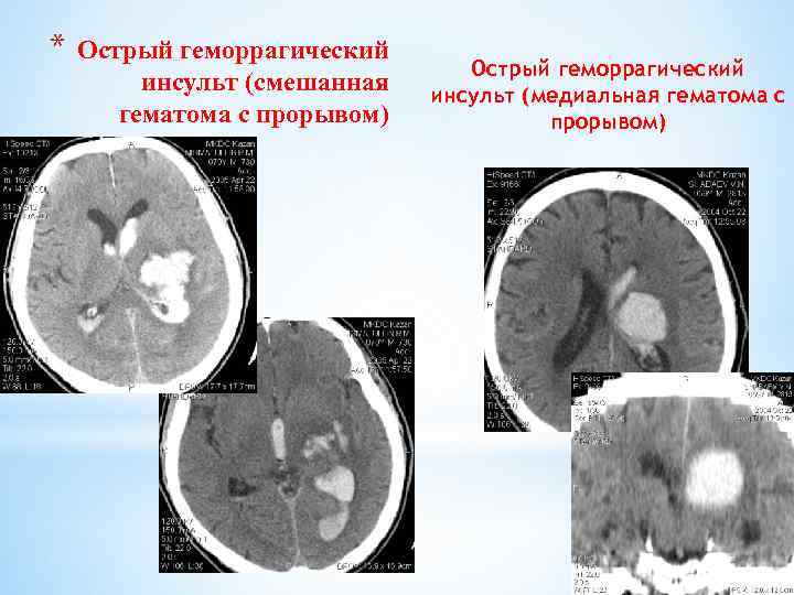 * Острый геморрагический инсульт (смешанная гематома с прорывом) Острый геморрагический инсульт (медиальная гематома с
