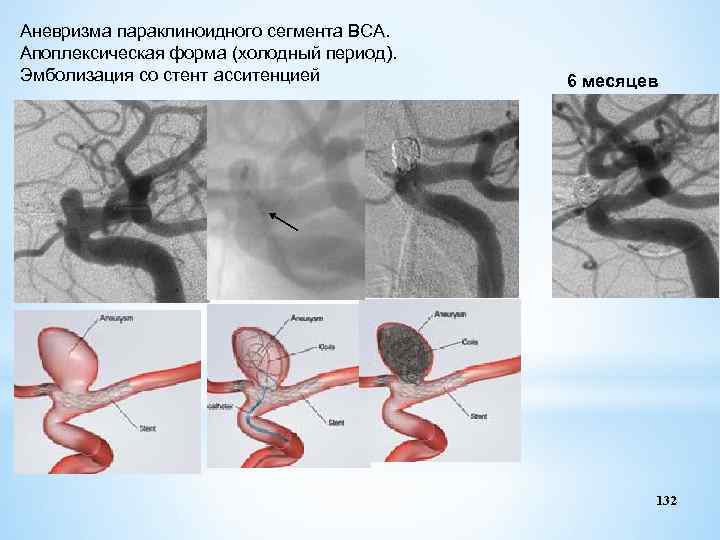 Аневризма параклиноидного сегмента ВСА. Апоплексическая форма (холодный период). Эмболизация со стент асситенцией 6 месяцев