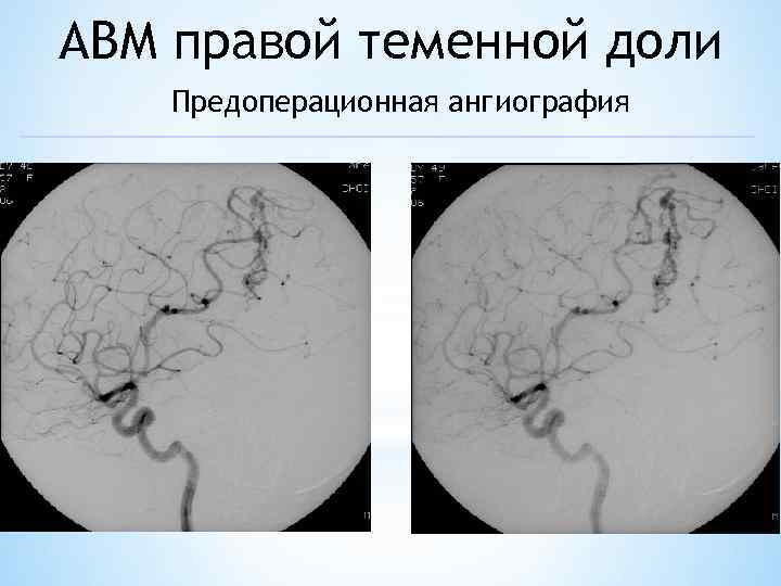 АВМ правой теменной доли Предоперационная ангиография 