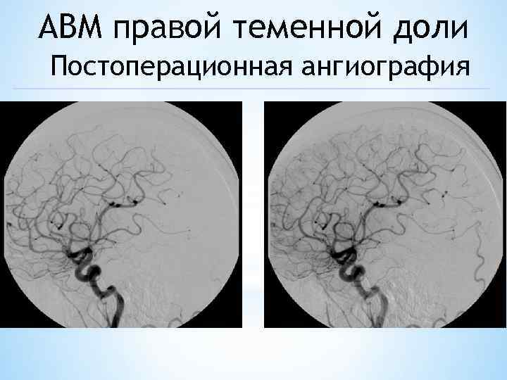 АВМ правой теменной доли Постоперационная ангиография 