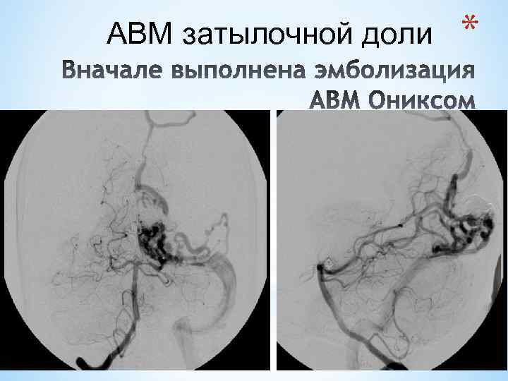 АВМ затылочной доли * 