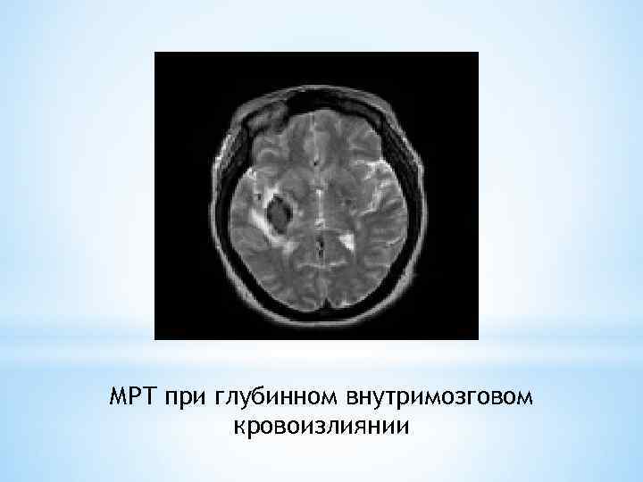 МРТ при глубинном внутримозговом кровоизлиянии 
