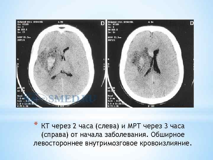 * КТ через 2 часа (слева) и МРТ через 3 часа (справа) от начала