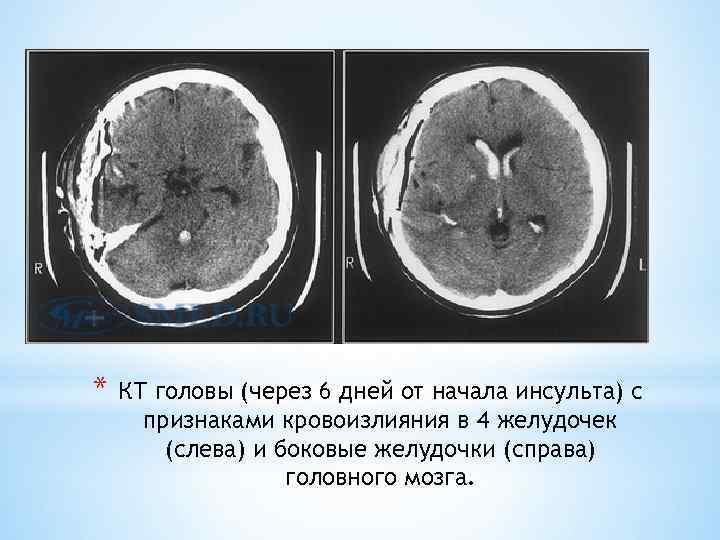 * КТ головы (через 6 дней от начала инсульта) с признаками кровоизлияния в 4