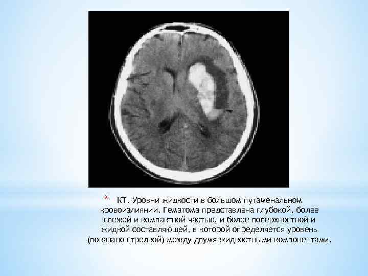 * КТ. Уровни жидкости в большом путаменальном кровоизлиянии. Гематома представлена глубокой, более свежей и