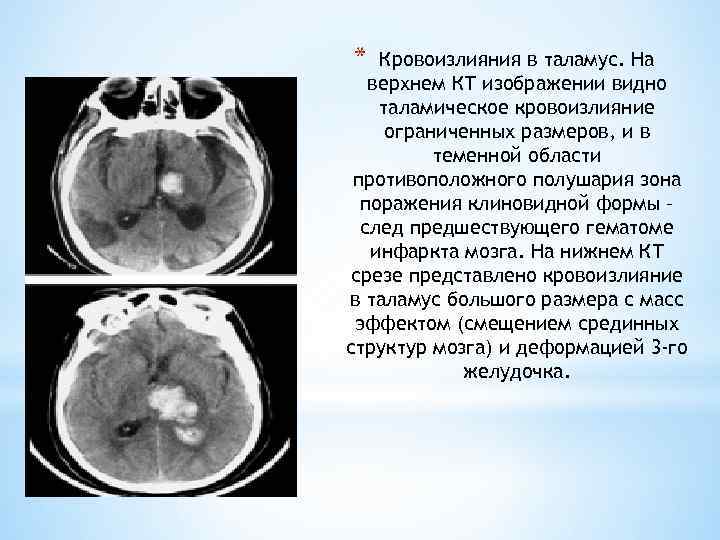 * Кровоизлияния в таламус. На верхнем КТ изображении видно таламическое кровоизлияние ограниченных размеров, и