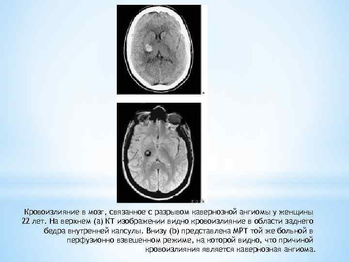 Кровоизлияние в мозг, связанное с разрывом кавернозной ангиомы у женщины 22 лет. На верхнем