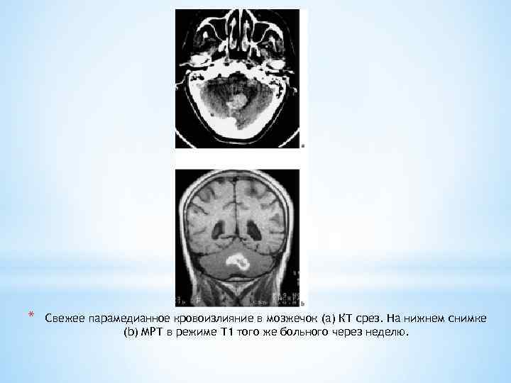 * Свежее парамедианное кровоизлияние в мозжечок (а) КТ срез. На нижнем снимке (b) МРТ