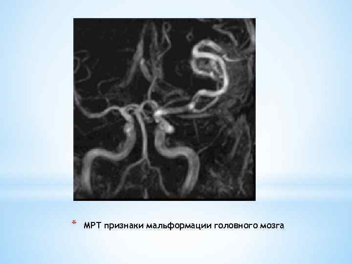 * МРТ признаки мальформации головного мозга 