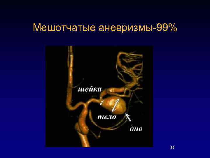 Мешотчатые аневризмы-99% 57 