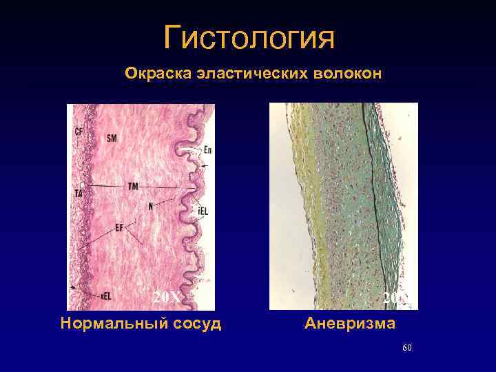 Гистология Окраска эластических волокон 20 X Нормальный сосуд 20 X Аневризма 60 