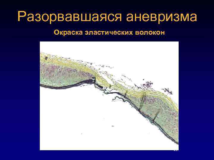 Разорвавшаяся аневризма Окраска эластических волокон Point of rupture 20 X 61 