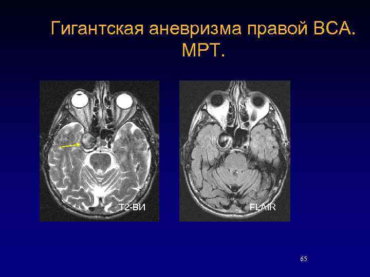 Гигантская аневризма правой ВСА. МРТ. Т 2 -ВИ FLAIR 65 