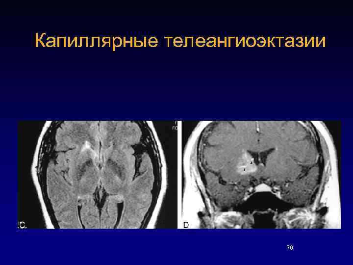 Капиллярные телеангиоэктазии 70 