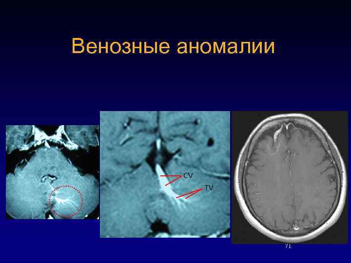 Венозные аномалии 71 