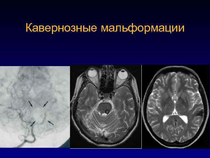 Кавернозные мальформации 73 