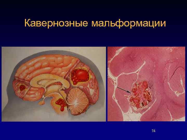 Кавернозные мальформации 74 