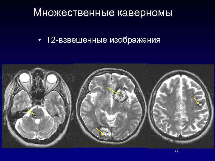 Множественные каверномы • Т 2 -взвешенные изображения 77 