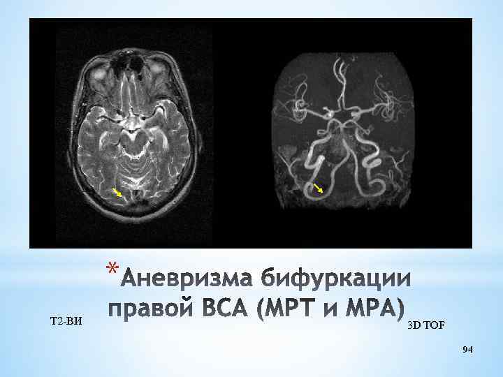 * Т 2 -ВИ 3 D TOF 94 