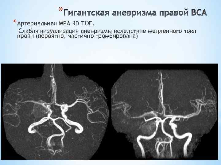 * * Артериальная МРА 3 D TOF. Слабая визуализация аневризмы вследствие медленного тока крови