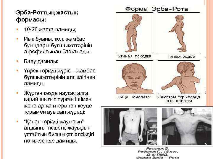 Эрба-Роттың жастық формасы: 10 -20 жаста дамиды; § Иық буыны, қол, жамбас буындары бұлшықеттерінің