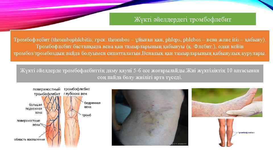 Жүкті әйелдердегі тромбофлебит Тромбофлебит (thrombophlebіtіs; грек. thrombos – ұйыған қан, phleps, phlebos – вена