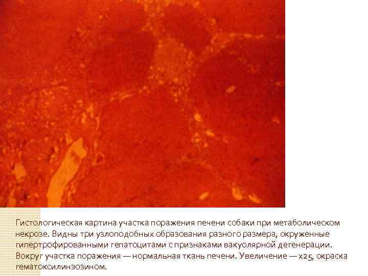 Гистологическая картина участка поражения печени собаки при метаболическом некрозе. Видны три узлоподобных образования разного